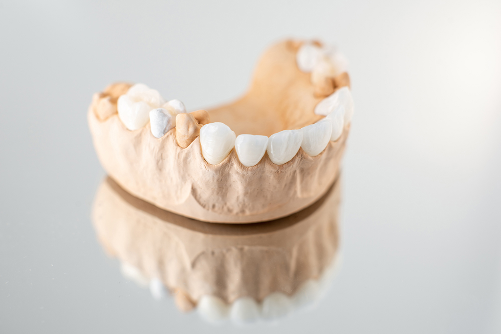 model of artificial jaw with veneers F6KMVE9