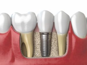 anatomy of healthy teeth and tooth dental implant PAF6ZMW 1