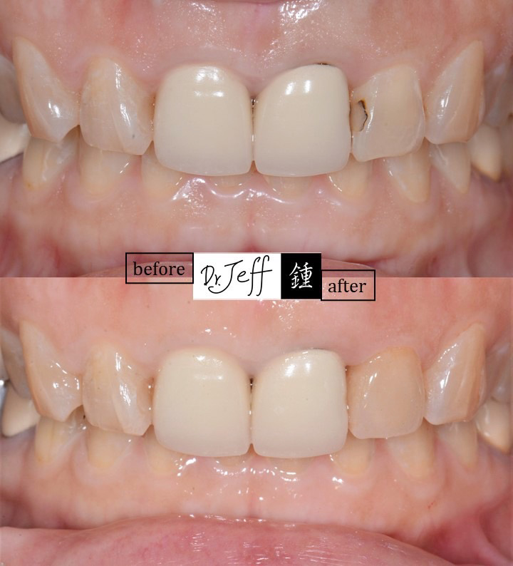 veneer 0323case1