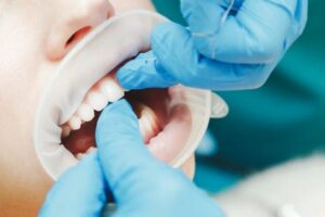 植牙 5 close up of female mouth with retractor doctor fl 2022 12 16 21 40 55 utc