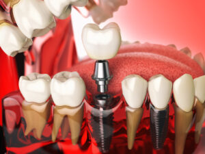 tooth implant in the model human teeth gums and d 2021 08 26 16 56 57 utc 1