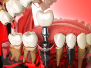植牙 5 tooth implant in the model human teeth gums and d 2021 08 26 16 56 57 utc 1