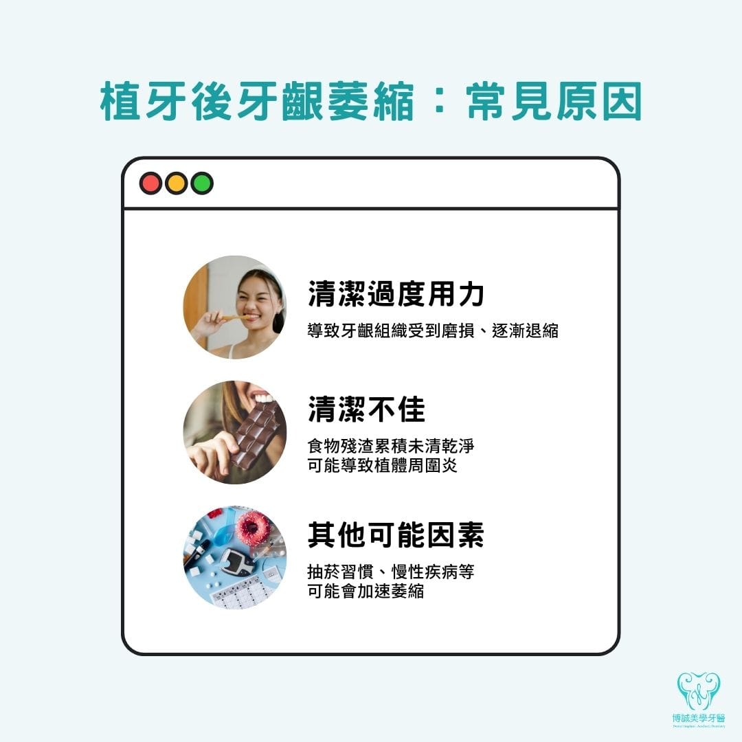 植牙後牙齦萎縮常見原因