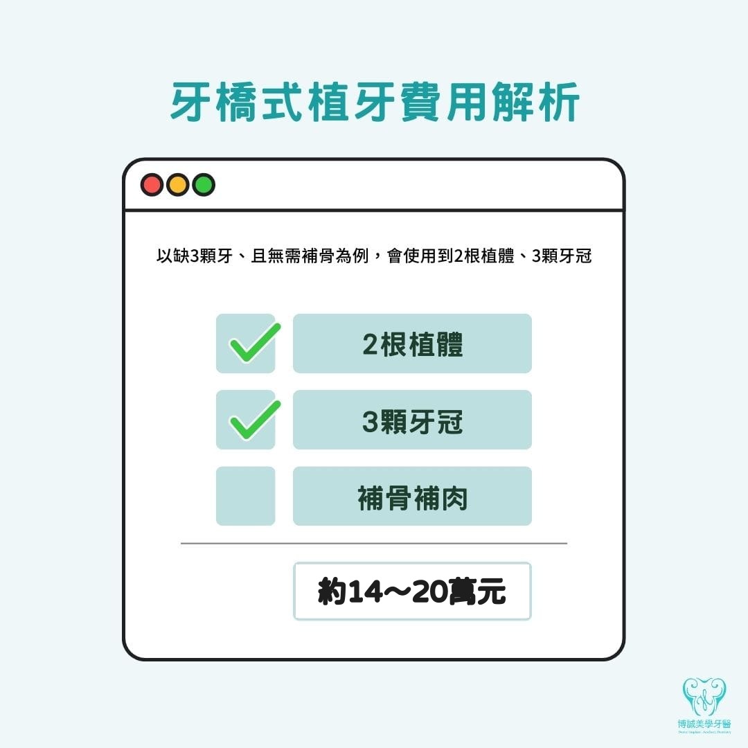 牙橋式植牙費用組成：植體2支加上假牙牙冠3顆，有補骨另計