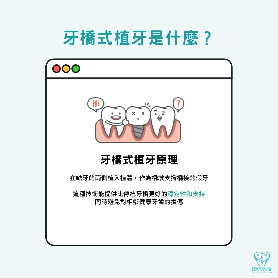 牙橋式植牙是什麼？