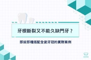 首頁 8 牙根斷裂又不能久缺門牙?即拔即種搭配全瓷牙冠的實際案例