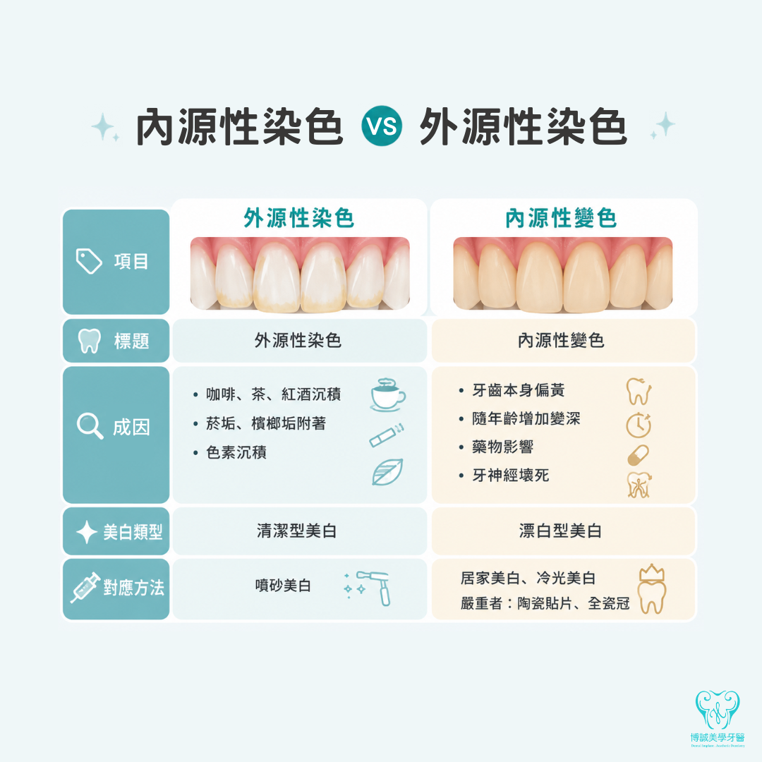 內源性染色與外源性染色差異比較，包含牙齒變黃原因、美白類型與適合的牙齒美白方式