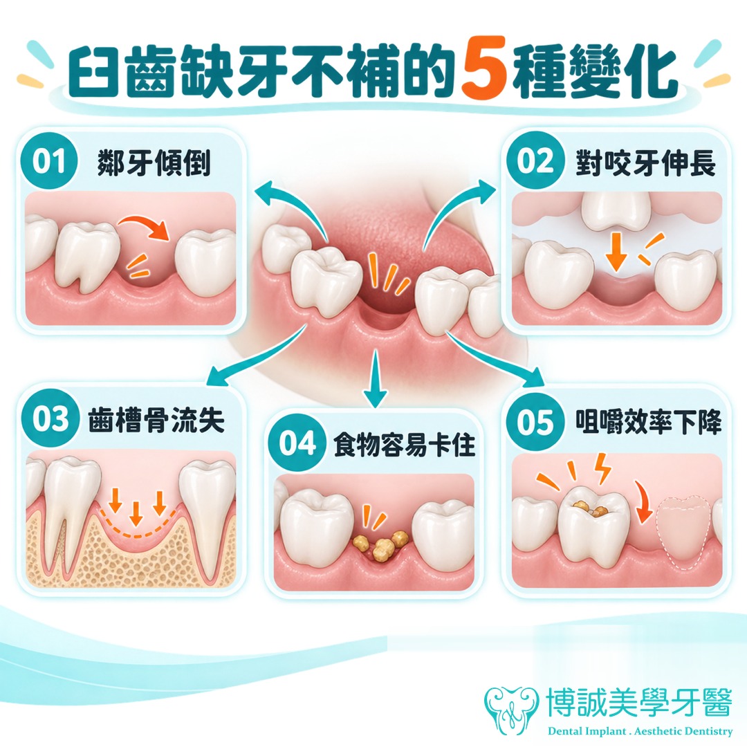臼齒缺牙不補的 5 種變化圖解：鄰牙傾倒、對咬牙伸長、齒槽骨流失、食物容易卡住、咀嚼效率下降